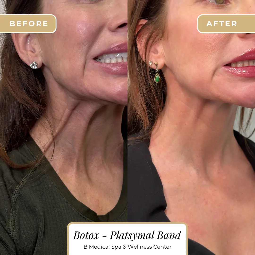 Beforafter-botox-B-Medical-Spa-and-Wellness-Center-San-Diego-CA