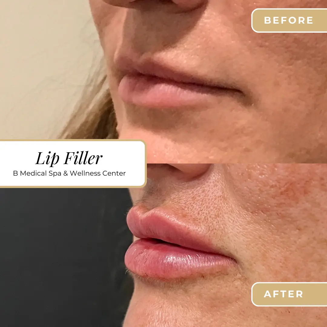 Beforafter-lip-filler-B-Medical-Spa-and-Wellness-Center-San-Diego-CA