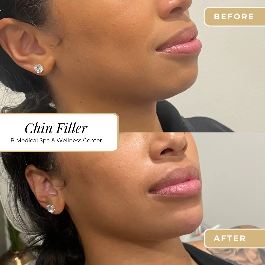 Chin-filler-B-Medical-Spa-and-Wellness-Center-San-Diego-CA