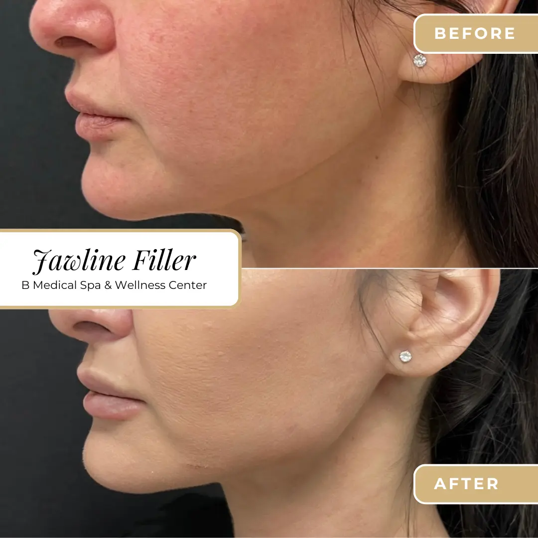 Jawline-Beforafter-B-Medical-Spa-and-Wellness-Center-San-Diego-CA