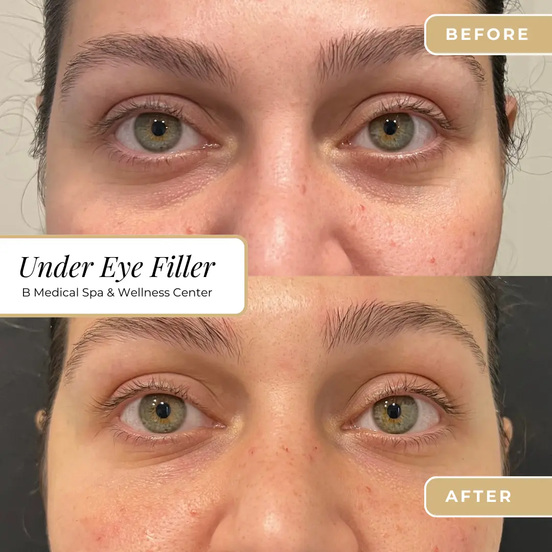 Under-eye-Beforafter-B-Medical-Spa-and-Wellness-Center-San-Diego-CA