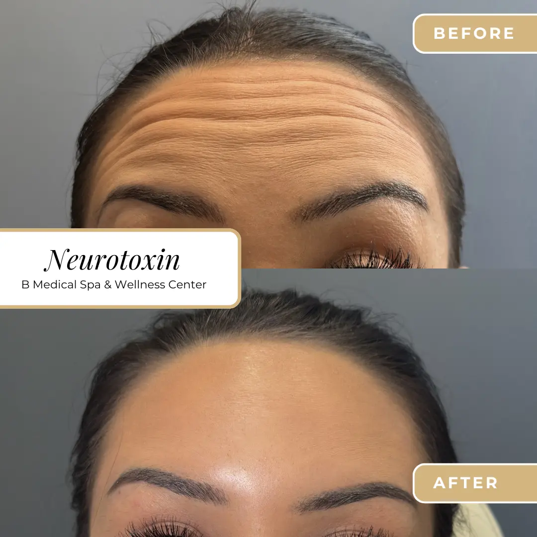 botox-Beforafter-B-Medical-Spa-and-Wellness-Center-San-Diego-CA