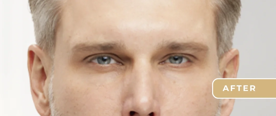 botox-service-img-beforeafter-by-B-Medical-Spa-and-Wellness-Center-San-Diego-CA