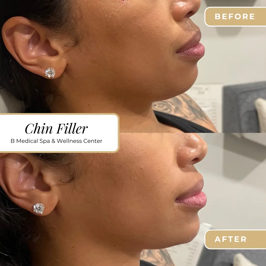 chinfiller-Beforafter-B-Medical-Spa-and-Wellness-Center-San-Diego-CA