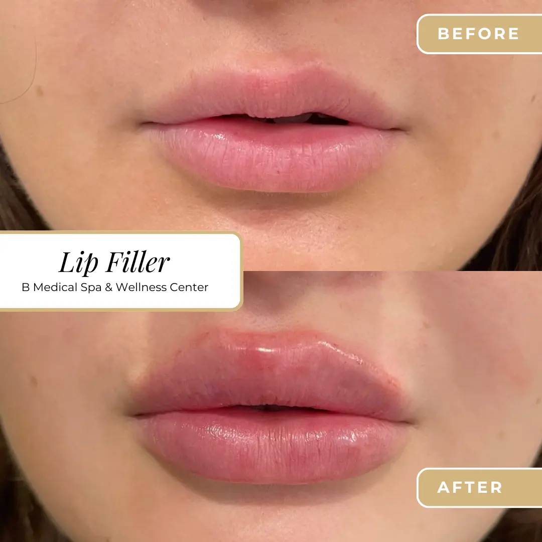 filler-Befor-after-B-Medical-Spa-and-Wellness-Center-San-Diego-CA
