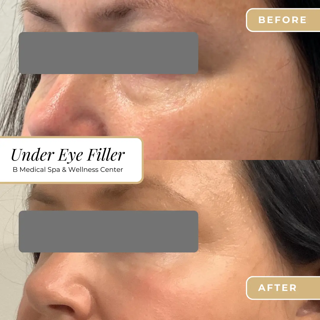 filler-Beforafter-B-Medical-Spa-and-Wellness-Center-San-Diego-CA