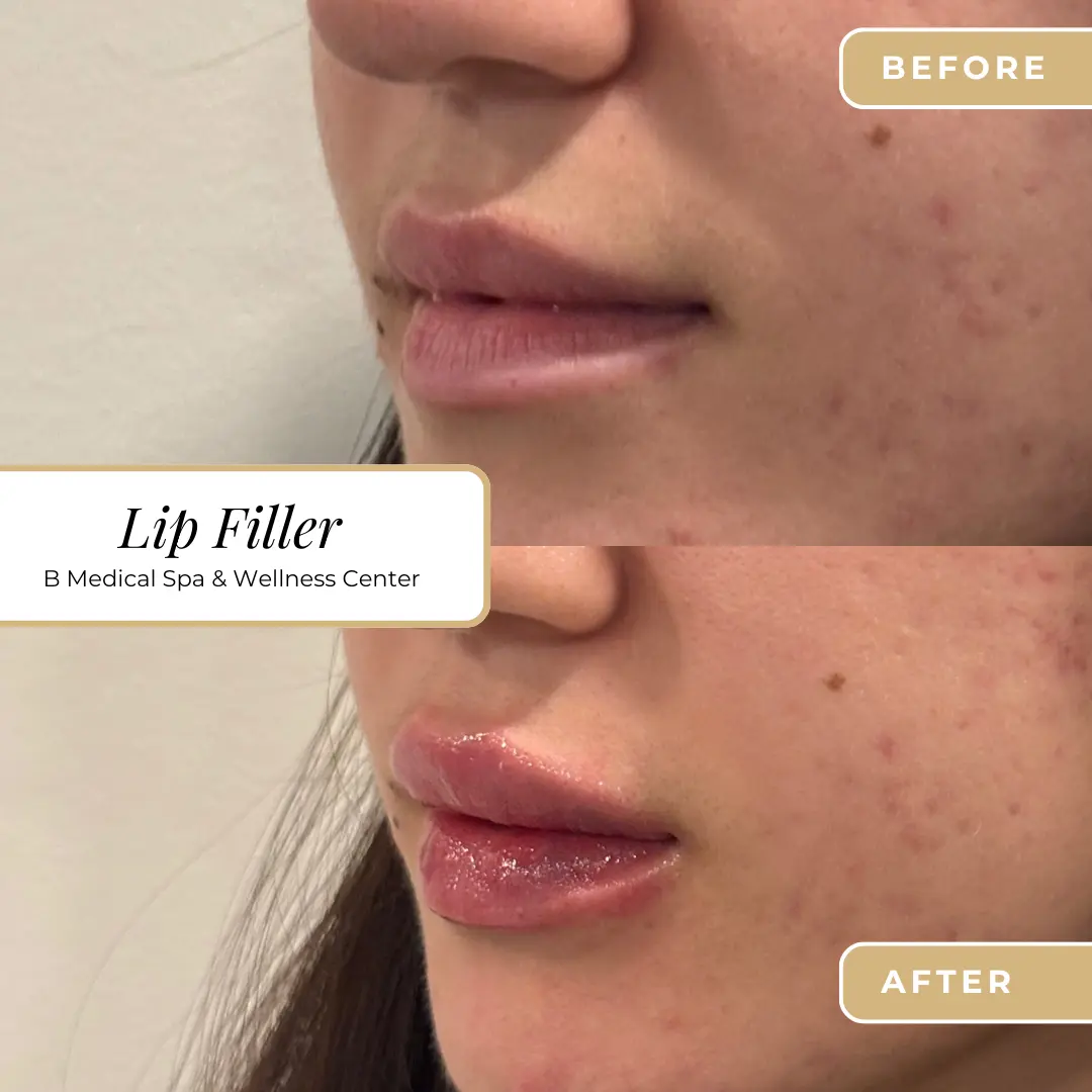 filler-Beforafter-lip-B-Medical-Spa-and-Wellness-Center-San-Diego-CA