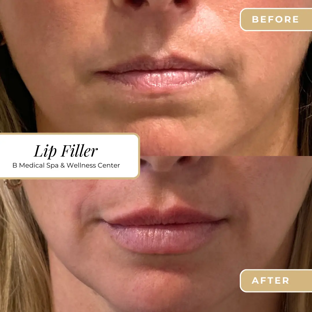 filler-lip-Beforafter-B-Medical-Spa-and-Wellness-Center-San-Diego-CA