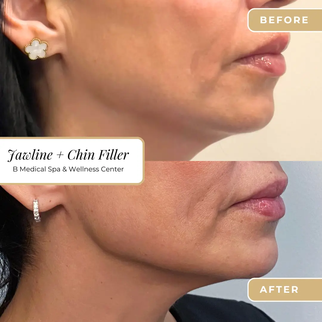 jawlin-chin-Beforafter-B-Medical-Spa-and-Wellness-Center-San-Diego-CA