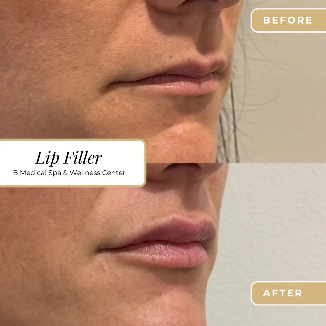 lip-fillers-Beforafter-B-Medical-Spa-and-Wellness-Center-San-Diego-CA