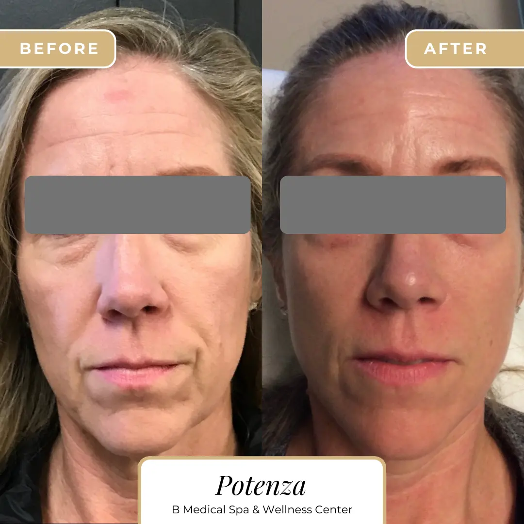 potenza-Beforafter-B-Medical-Spa-and-Wellness-Center-San-Diego-CA