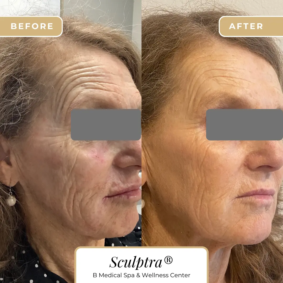 sculptra-Beforafter-B-Medical-Spa-and-Wellness-Center-San-Diego-CA