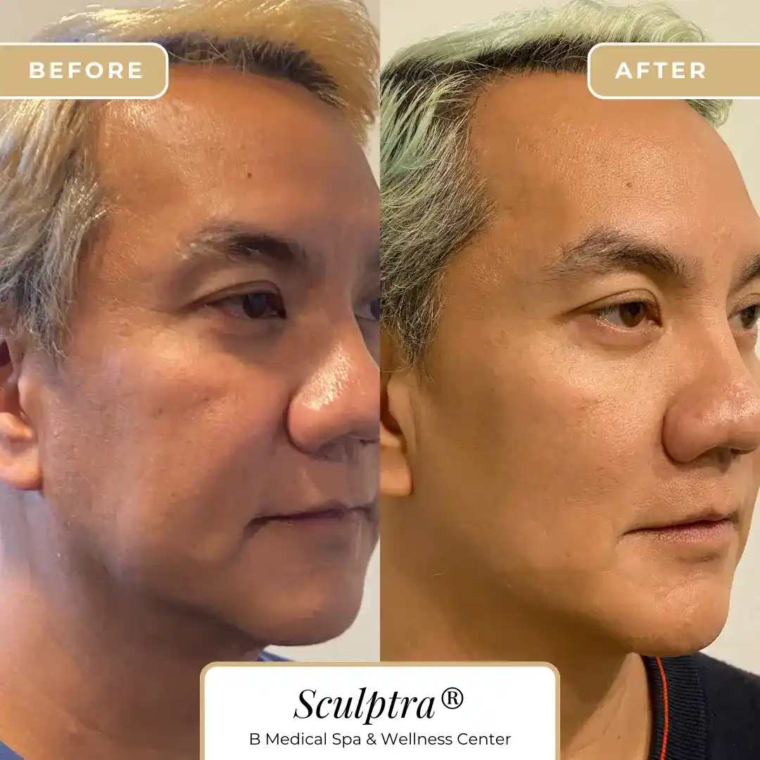 sculptra_beforeafter-in-San-Diego-CA