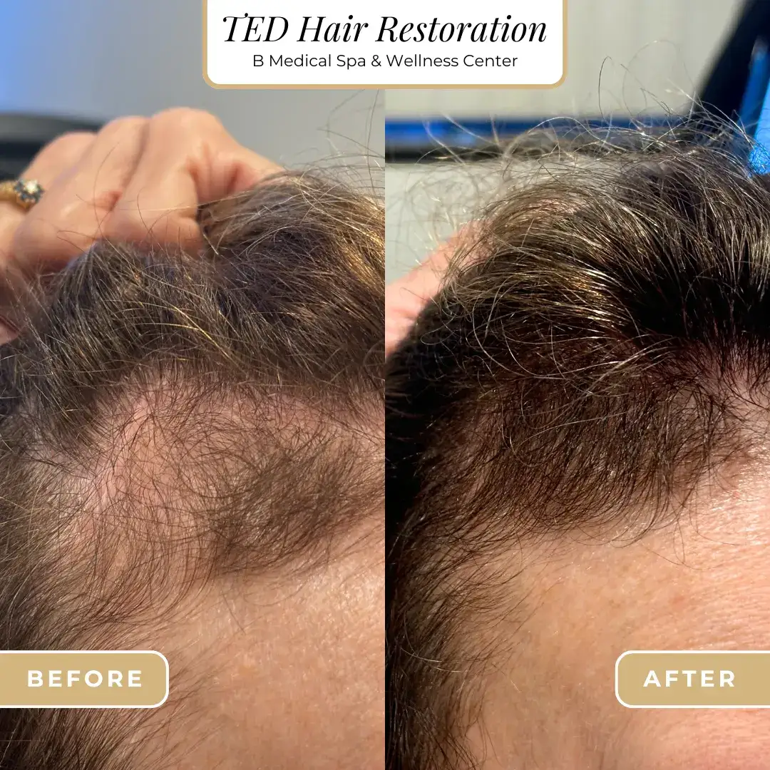 ted-before-after-B-Medical-Spa-and-Wellness-Center-San-Diego-CA