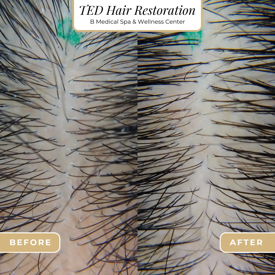 ted-beforeafter-B-Medical-Spa-and-Wellness-Center-San-Diego-CA