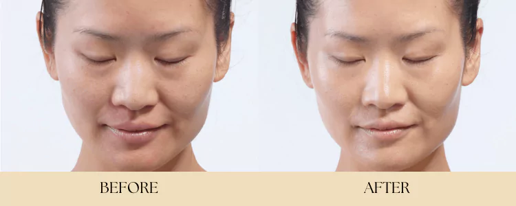 diamondglow-beforeandafter-by-B-Medical-Spa-and-Wellness-Center-San-Diego-CA