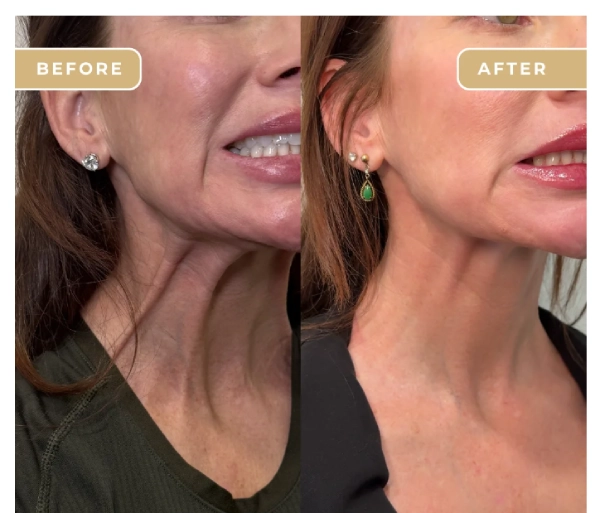 home-botox-B-Medical-Spa-and-Wellness-Center-San-Diego-CA home-botox-B-Medical-Spa-and-Wellness-Center-San-Diego-CA