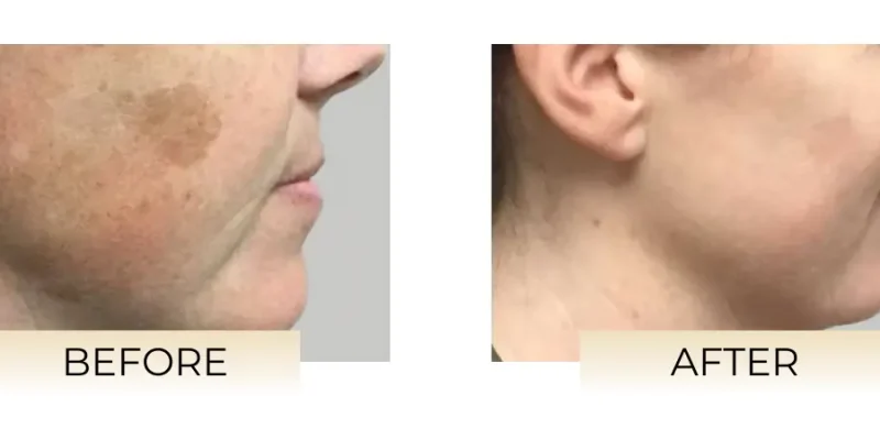 IPL_beforeandafter_photo-B-Medical-Spa-and-Wellness-Center-San-Diego-CA